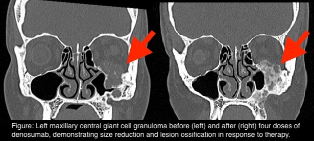 5f3781d65d3ec-PQ+-+Coronal+pre+and+post+arrowed+captioned+3.jpeg