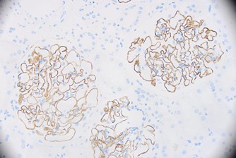 6864518d50ad6-IgG4+Staining.jpg